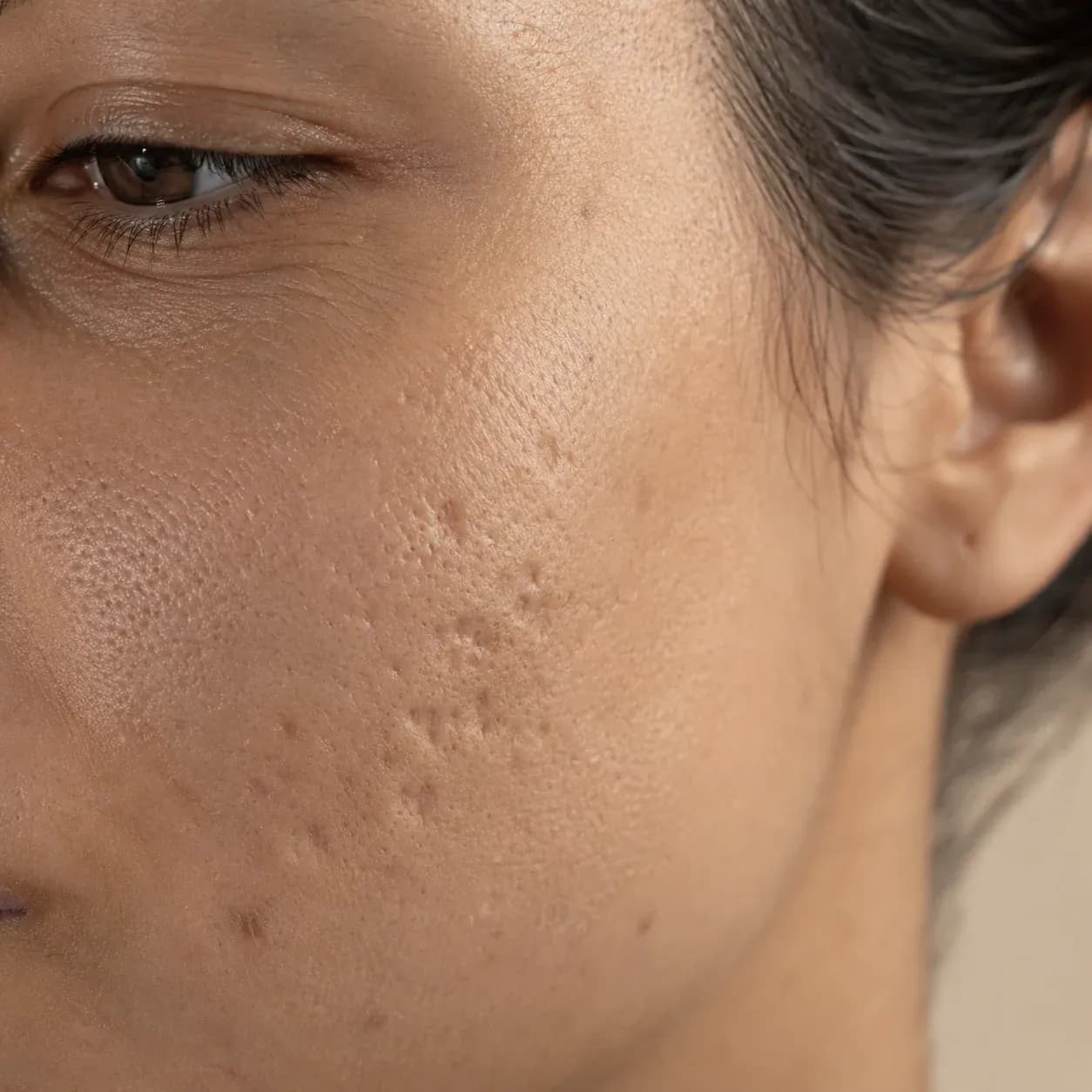 Microneedling